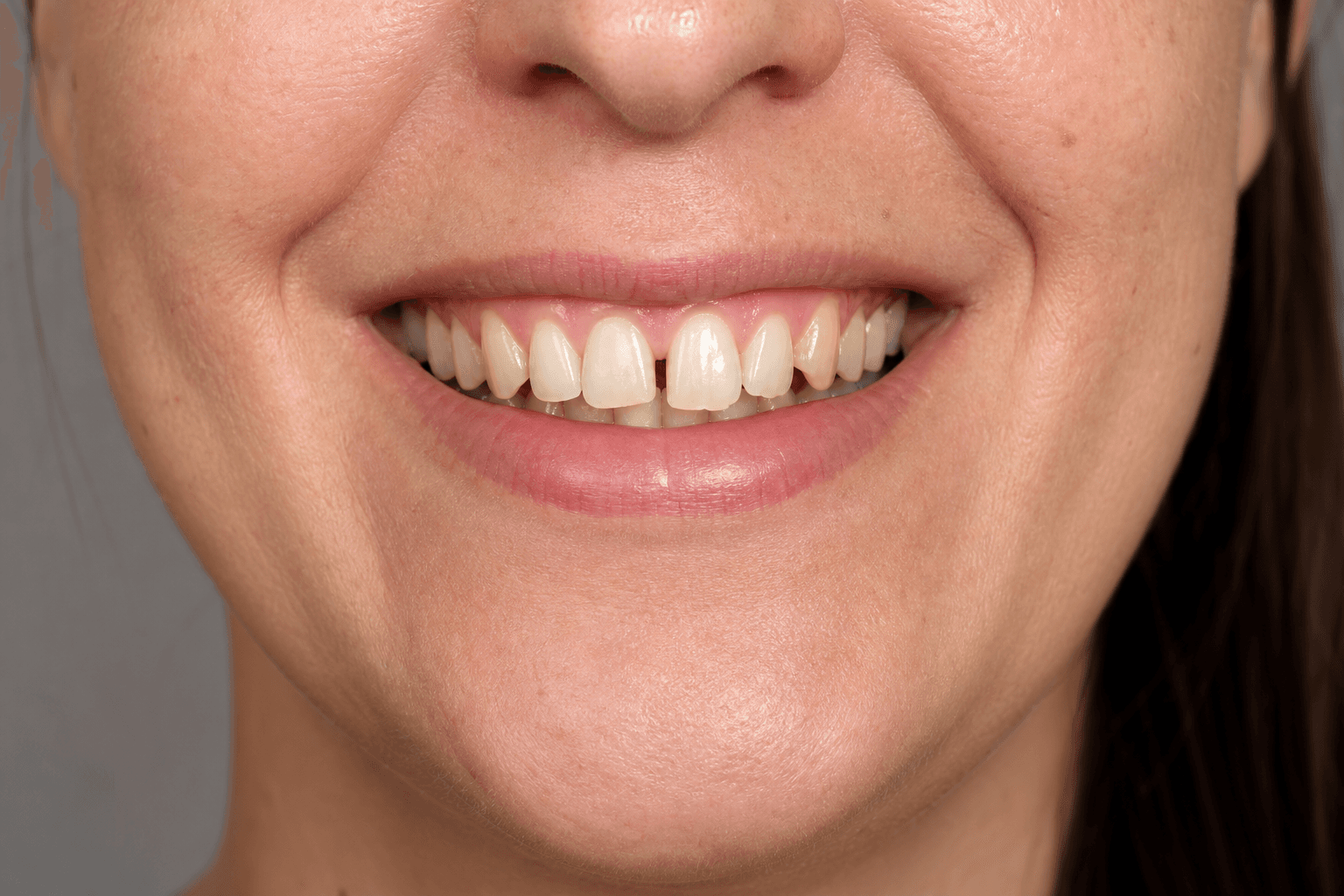 Smile treatment comparison